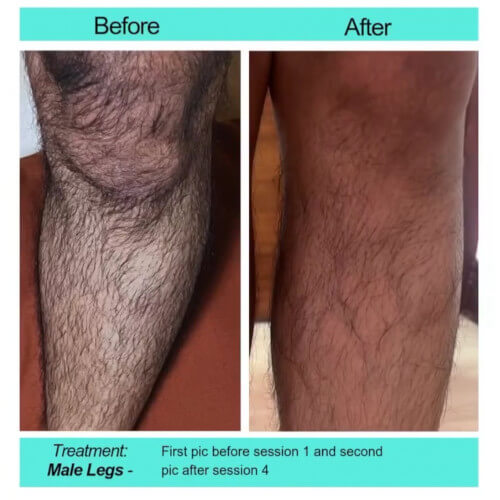 Before and After picture of male legs